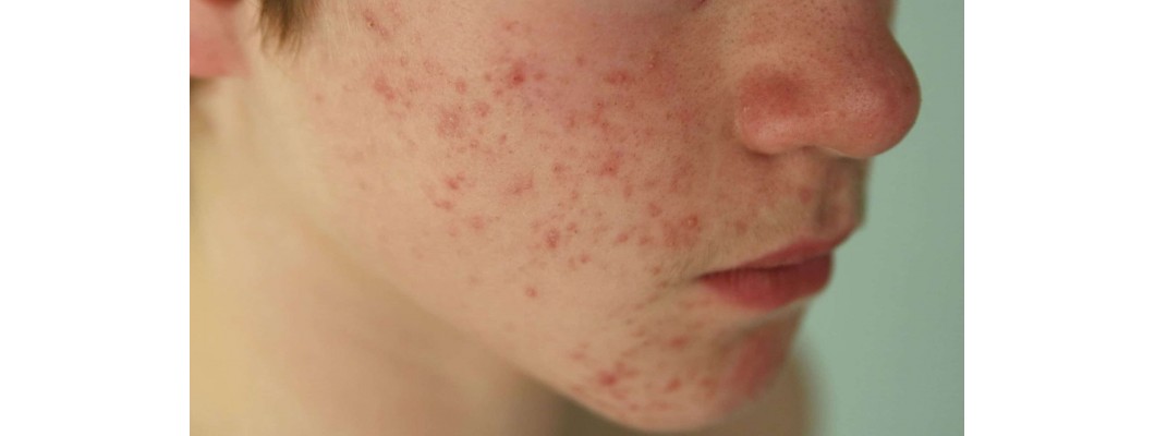 How Homeopathy Helps In Treating Skin Conditions like Melasma and Fungal Infections