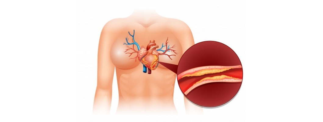 Homeopathy Medicine For Cholesterol