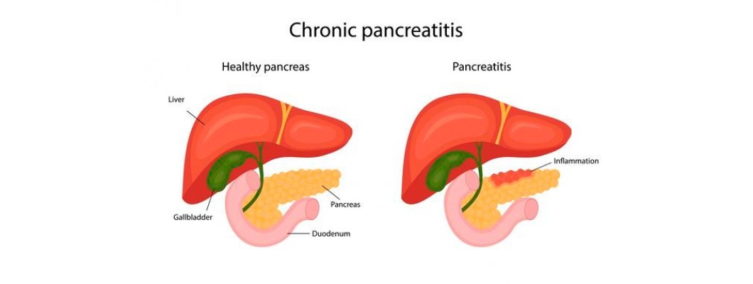 Homeopathy Treatment for ACUTE PANCREATITIS