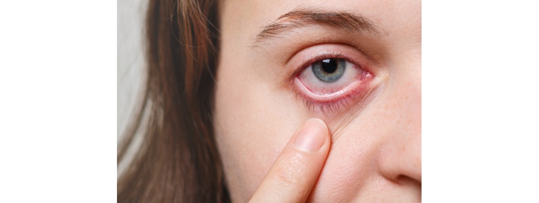 Conjunctivitis types and symptoms